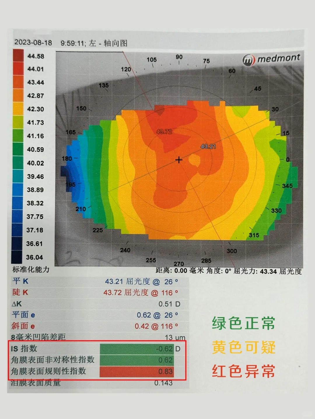 孩子角膜是否有特殊情況，就看這幾個(gè)數(shù)值_1_小樹眼科青少年近視防控_來自小紅書網(wǎng)頁版